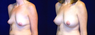 Left 3/4 View - Breast Augmentation After Pregnancy with Silicone Implants