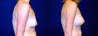 Right Profile View - Breast Augmentation After Pregnancy with Silicone Implants