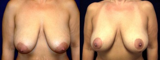 Frontal View - Breast Lift After Pregnancy