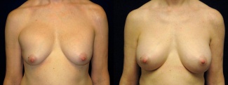 Frontal View - Breast Implant Revision