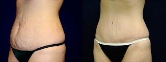 Left 3/4 View - Tummy Tuck After Pregnancy