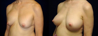 Left 3/4 View - Breast Implant Revision