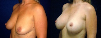 Left 3/4 View - Breast Augmentation with Lift - Silicone Implants