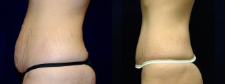 Left Profile View - Tummy Tuck After Pregnancy