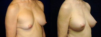 Right 3/4 View - Breast Implant Revision