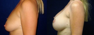 Left Profile View - Breast Augmentation with Lift - Silicone Implants