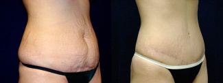 Right 3/4 View - Tummy Tuck After Pregnancy