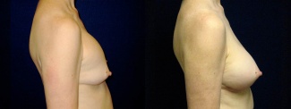 Right Profile View - Breast Implant Revision