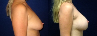 Right Profile View - Breast Augmentation with Lift - Silicone Implants