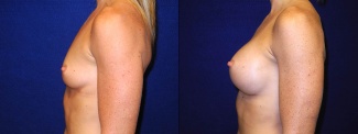 Left Profile View - Breast Augmentation - Silicone Implants