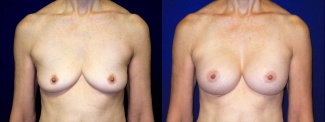 Frontal View - Breast Augmentation - Silicone Implants