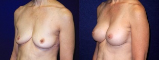 Left 3/4 View - Breast Augmentation - Silicone Implants