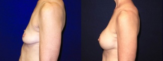 Left Profile View - Breast Augmentation - Silicone Implants