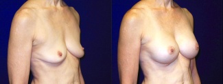 Right 3/4 View - Breast Augmentation - Silicone Implants