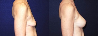 Right Profile View - Breast Augmentation - Silicone Implants