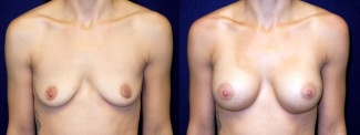 Frontal View - Breast Augmentation - Silicone Implants