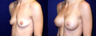 Left 3/4 View - Breast Augmentation - Silicone Implants