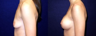 Left Profile View - Breast Augmentation - Silicone Implants