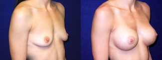 Right 3/4 View - Breast Augmentation - Silicone Implants