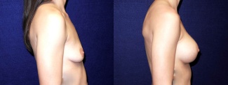 Right Profile View - Breast Augmentation - Silicone Implants