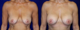 Frontal View - Breast Augmentation - Silicone Implants