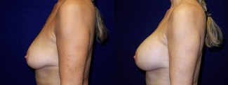 Left Profile View - Breast Augmentation - Silicone Implants