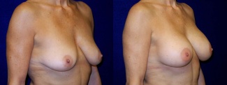 Right 3/4 View - Breast Augmentation - Silicone Implants