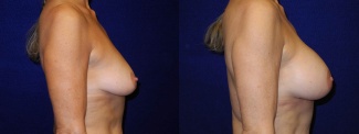 Right Profile View - Breast Augmentation - Silicone Implants