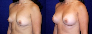 Left 3/4 View - Breast Augmentation - Silicone Implants