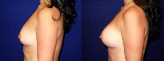 Left Profile View - Breast Augmentation - Silicone Implants