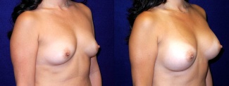 Right 3/4 View - Breast Augmentation - Silicone Implants