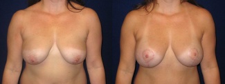 Frontal View - Breast Augmentation with Lift - Silicone Implants