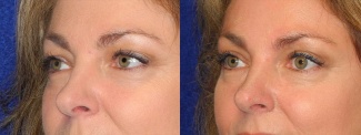 Left 3/4 View - Upper Eyelid Surgery