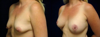 Left 3/4 View - Breast Augmentation with Lift