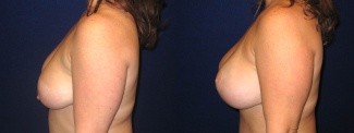 Left Profile View - Breast Augmentation with Lift - Silicone Implants