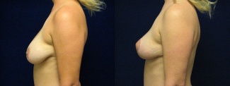 Left Profile View - Breast Lift 