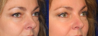 Right 3/4 View - Upper Eyelid Surgery