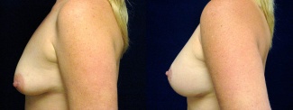 Left Profile View - Breast Augmentation with Lift