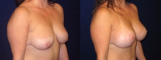 Right 3/4 View - Breast Augmentation with Lift - Silicone Implants