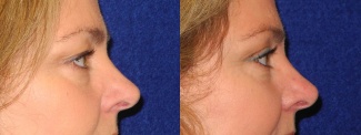 Right Profile View - Upper Eyelid Surgery