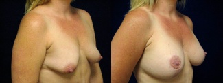 Right 3/4 View - Breast Augmentation with Lift