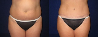 Frontal View - Tummy Tuck After Pregnancy