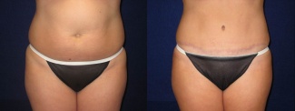 Frontal View - Tummy Tuck After Pregnancy