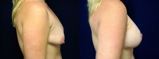 Right Profile View - Breast Augmentation with Lift