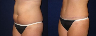 Left 3/4 View - Tummy Tuck After Pregnancy