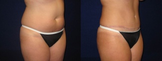 Right 3/4 View - Tummy Tuck After Pregnancy