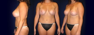 Full View - Breast Augmentation with Lift and Tummy Tuck After Pregnancy