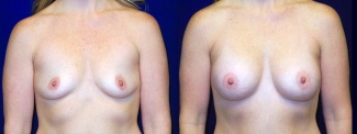 Frontal View - Breast Augmentation - Silicone Implants