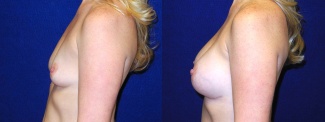 Left 3/4 View - Breast Augmentation - Silicone Implants