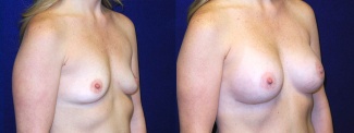 Right 3/4 View - Breast Augmentation - Silicone Implants